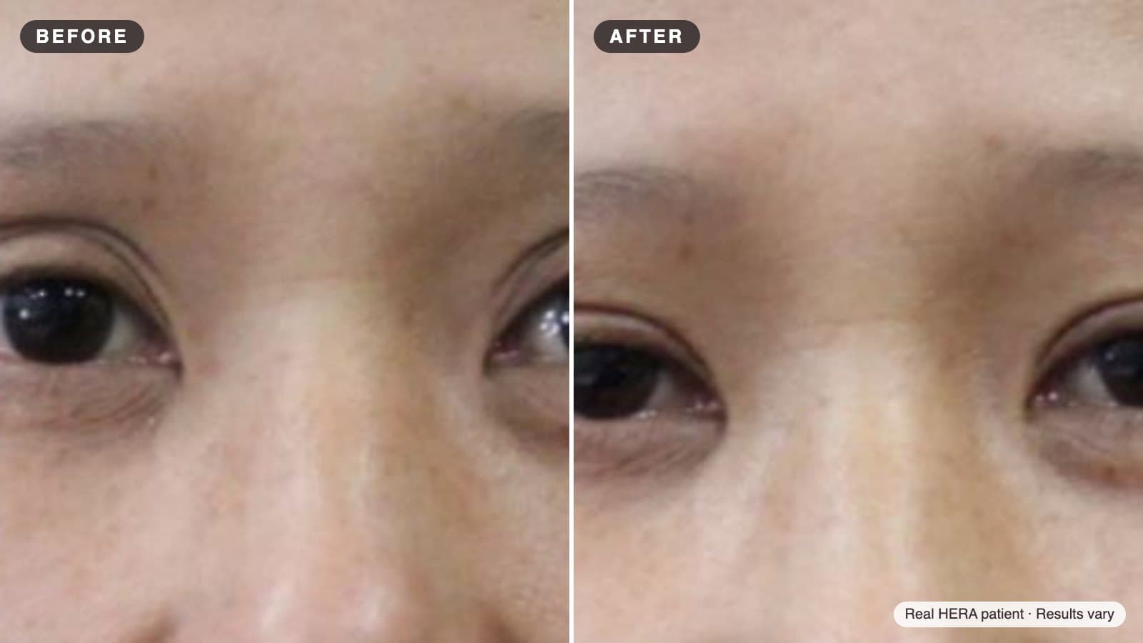 Eye Filler Cost in Korea: What Sets the Price for Sunken Eyes
