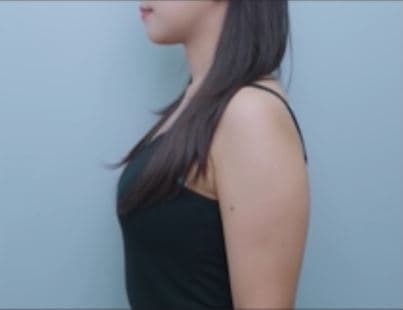 Sok-Sok Body Injection — Before