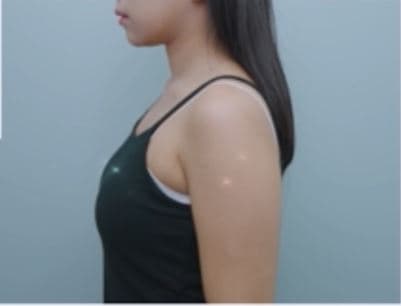 Sok-Sok Body Injection — After