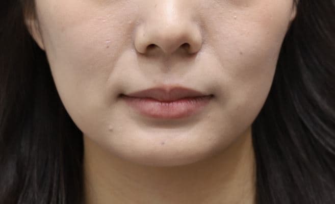 Chin Filler β Before