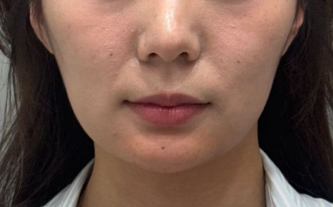 C-Line Lifting Filler — after