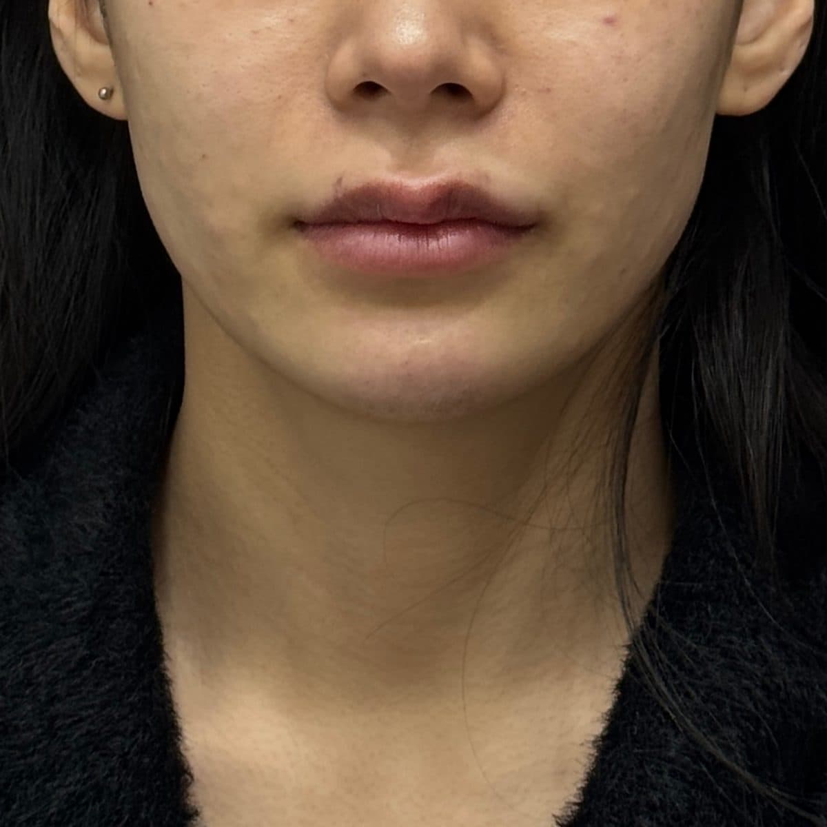 C-Line Lifting Filler — after