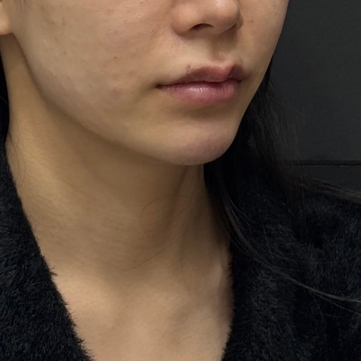 C-Line Lifting Filler — after