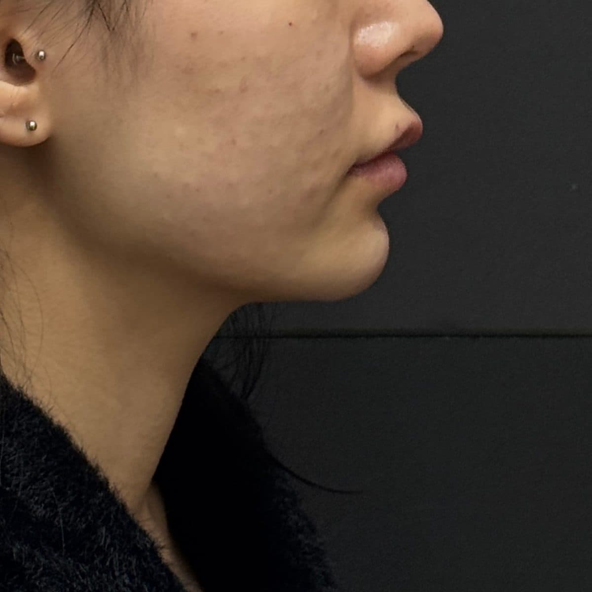 C-Line Lifting Filler — after