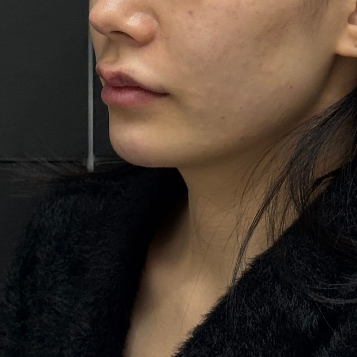 C-Line Lifting Filler — after
