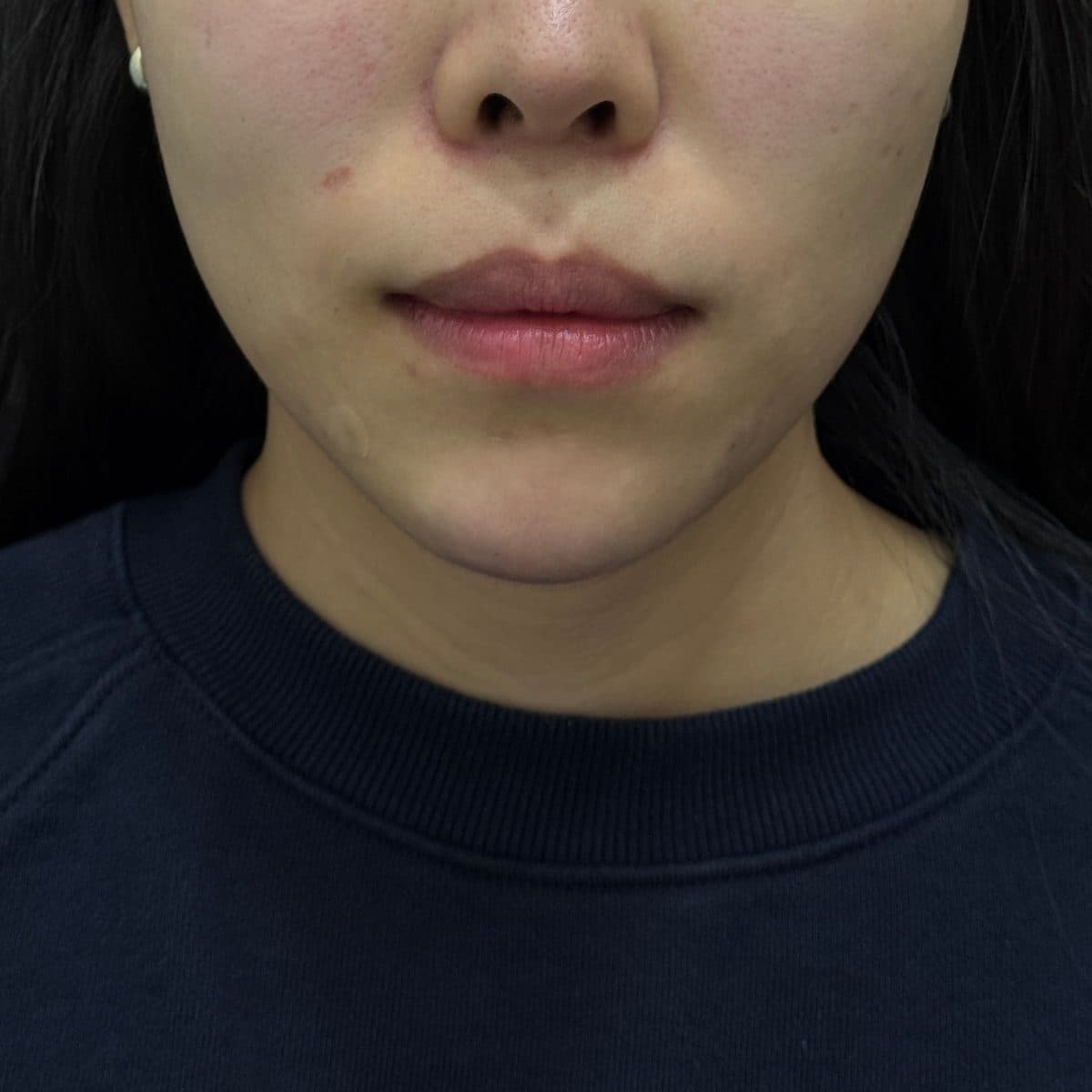 C-Line Lifting Filler — after