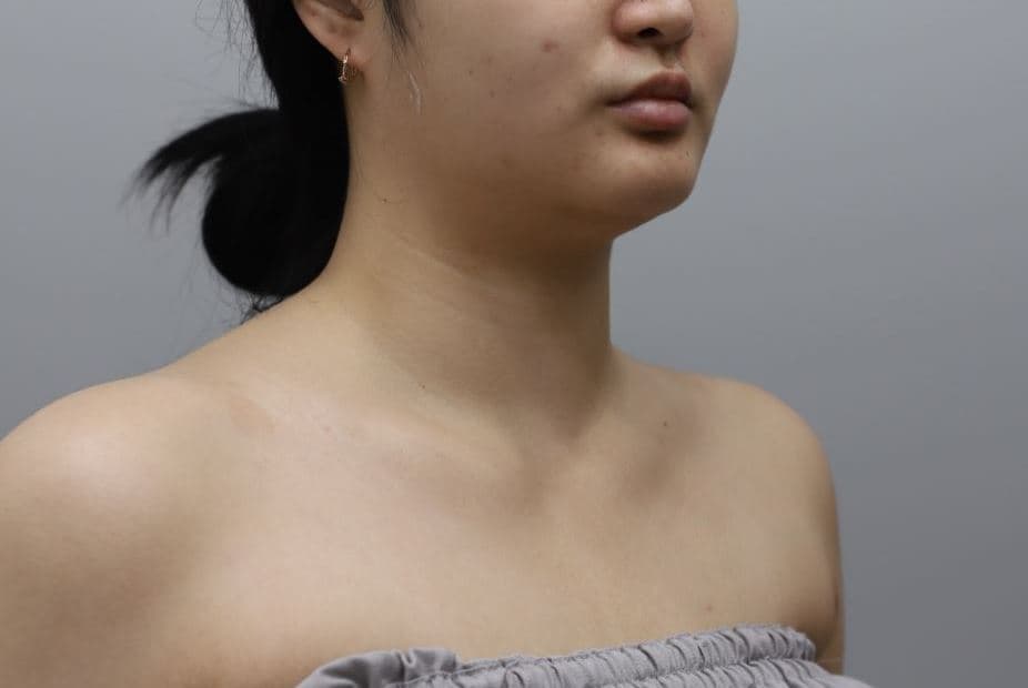Shoulder & Collarbone Filler — after