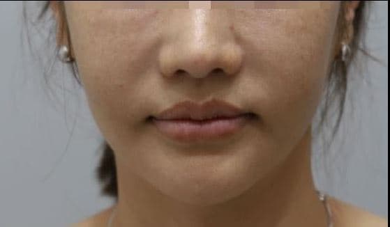 Sok-Sok Face Injection — After
