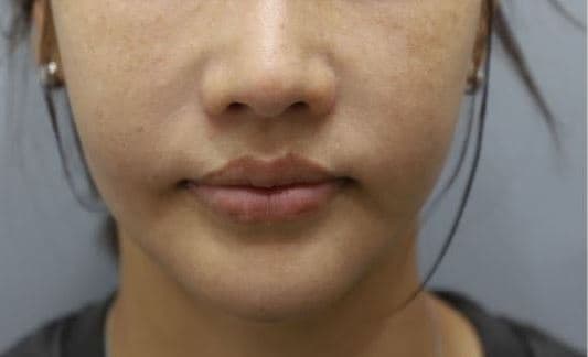 Sok-Sok Face Injection — Before
