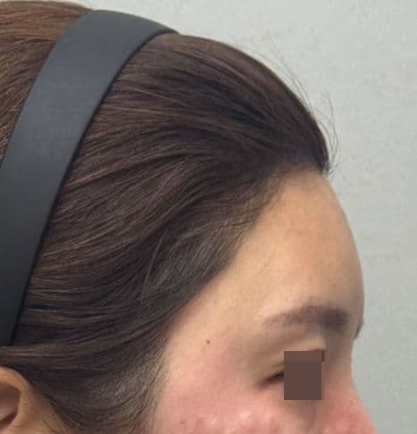 C-Line Lifting Filler — after