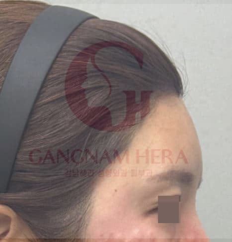 C-Line Lifting Filler — after