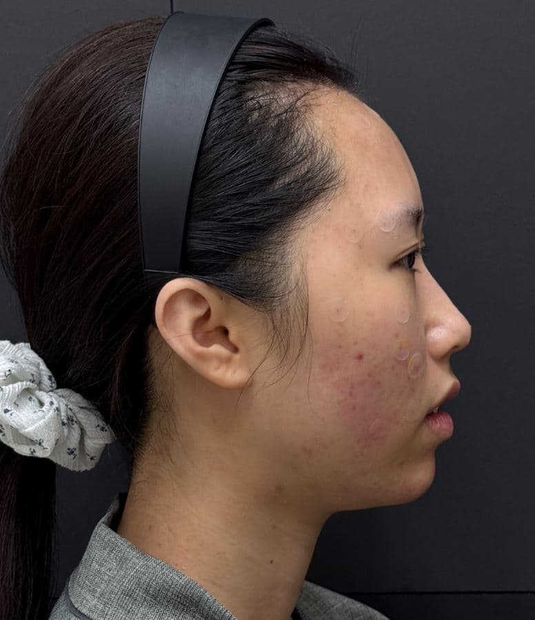 General Facial Fillers — after
