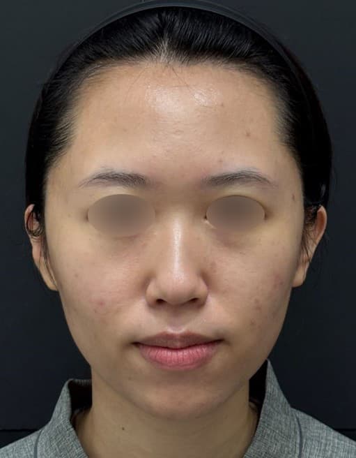General Facial Fillers — Before