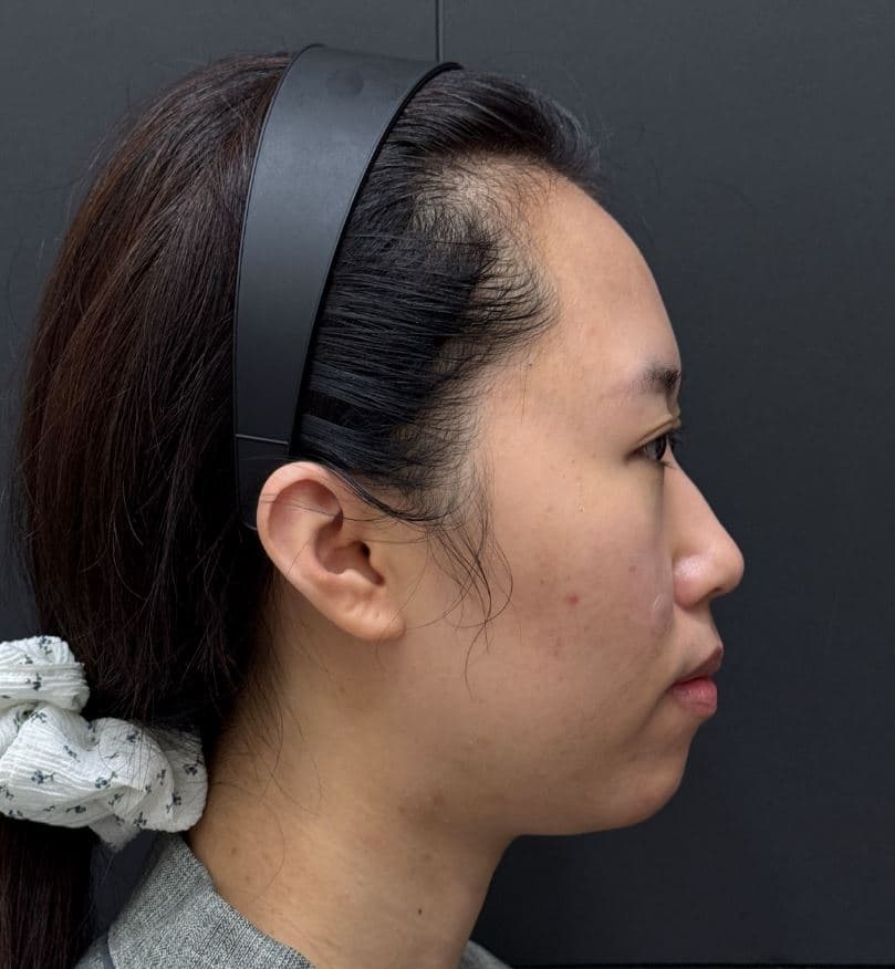 General Facial Fillers — Before