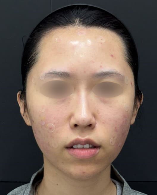 General Facial Fillers — after