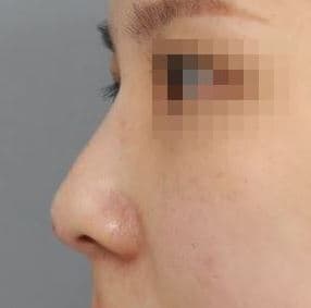 Nose Filler — after