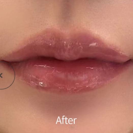 Lip Filler — after