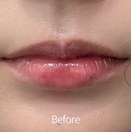 Lip Filler β Before