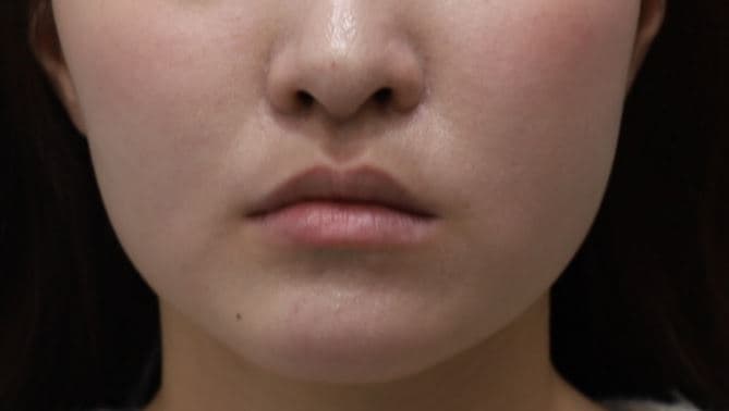 Lip Filler β Before