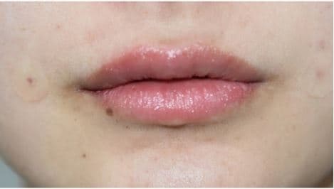 Lip Filler — after