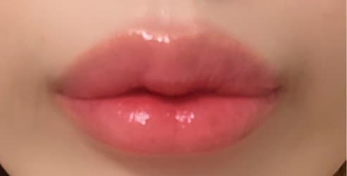 Lip Filler — after
