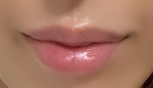 입술 필러 — 전