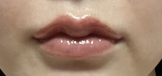 Lip Filler — after
