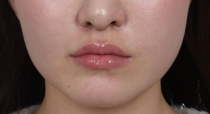 Lip Filler — after