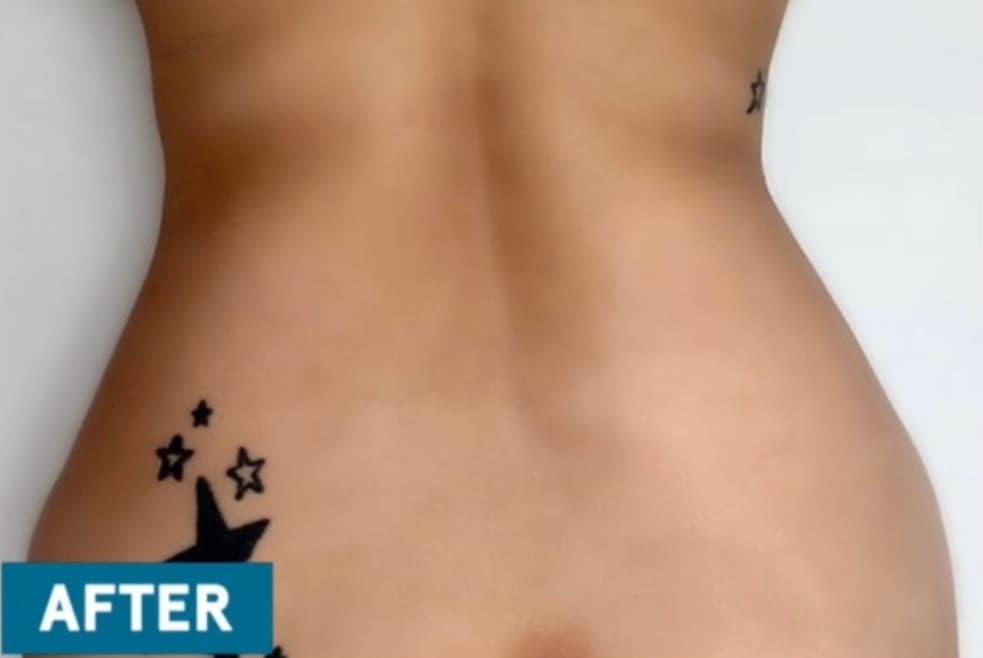Sok-Sok Body Injection — after