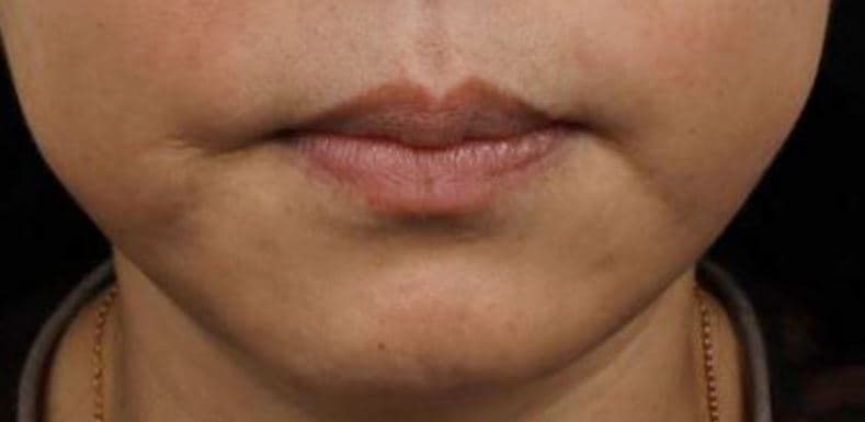 General Facial Fillers — Before