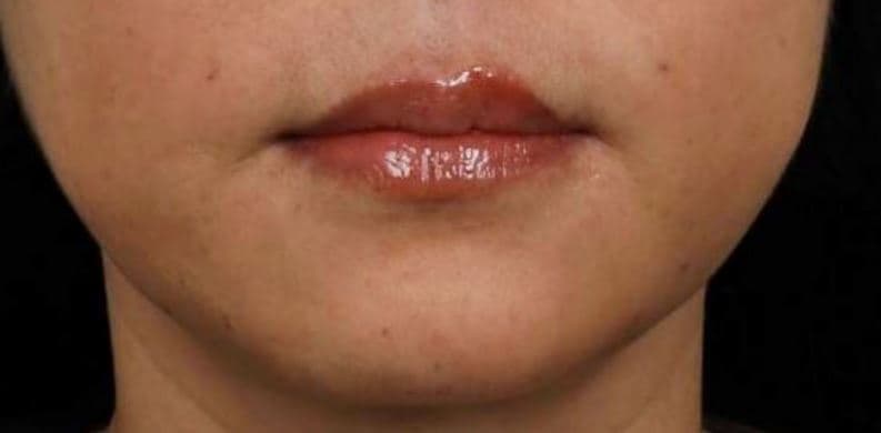 General Facial Fillers — after