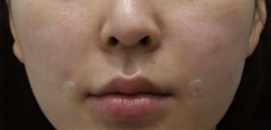 General Facial Fillers — after