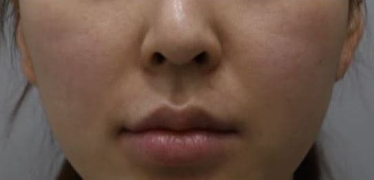 General Facial Fillers — Before