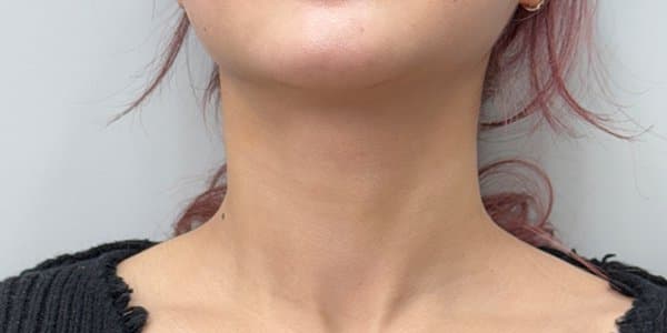 Neck Line Filler — after