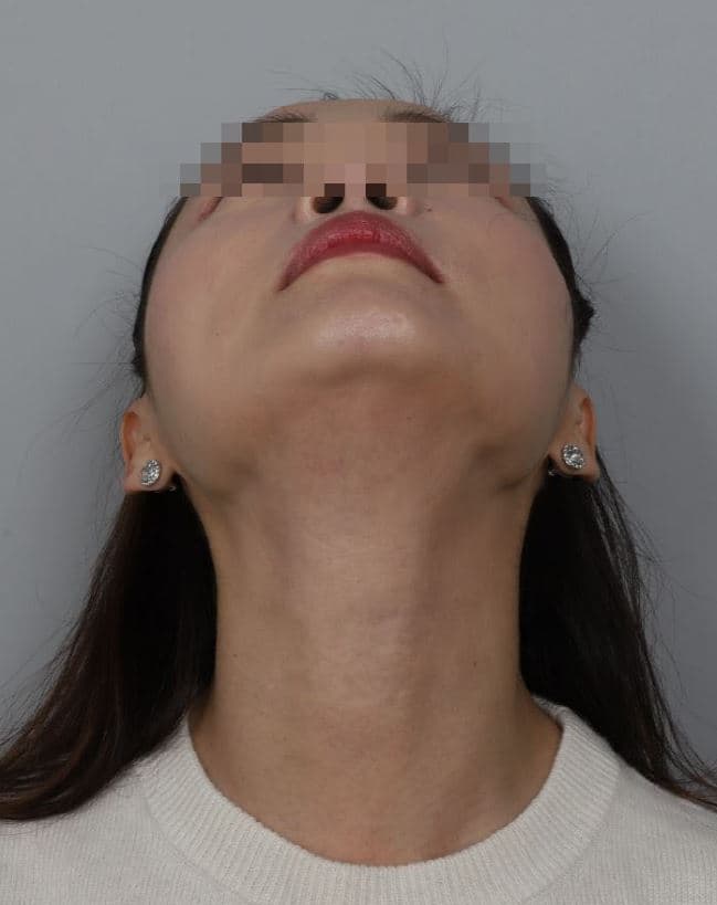 Neck Line Filler — after