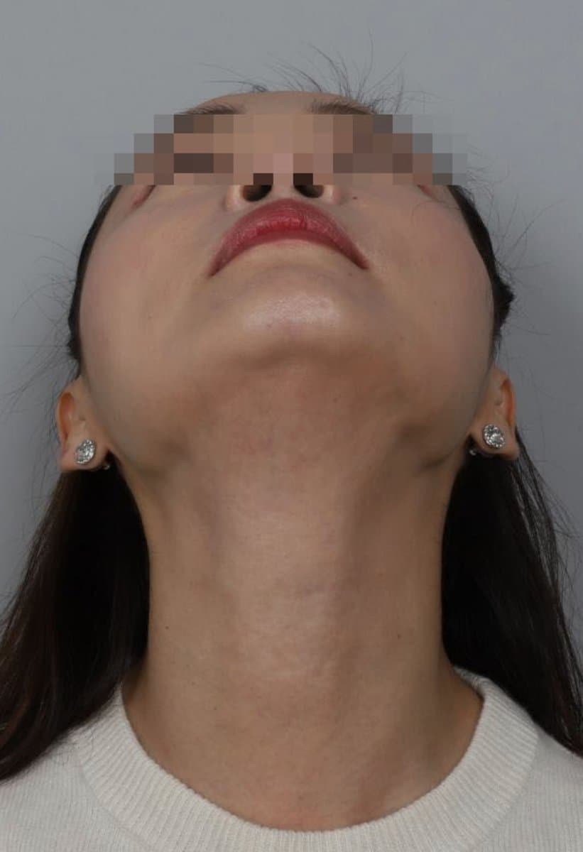 Neck Line Filler — after