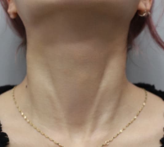 Neck Line Filler — after