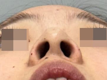 Nose Filler — after