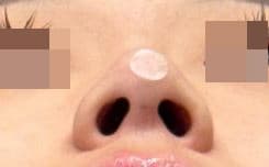 Nose Filler — after