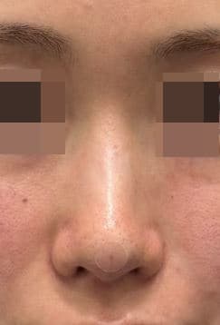 Nose Filler — after
