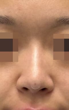 Nose Filler — after