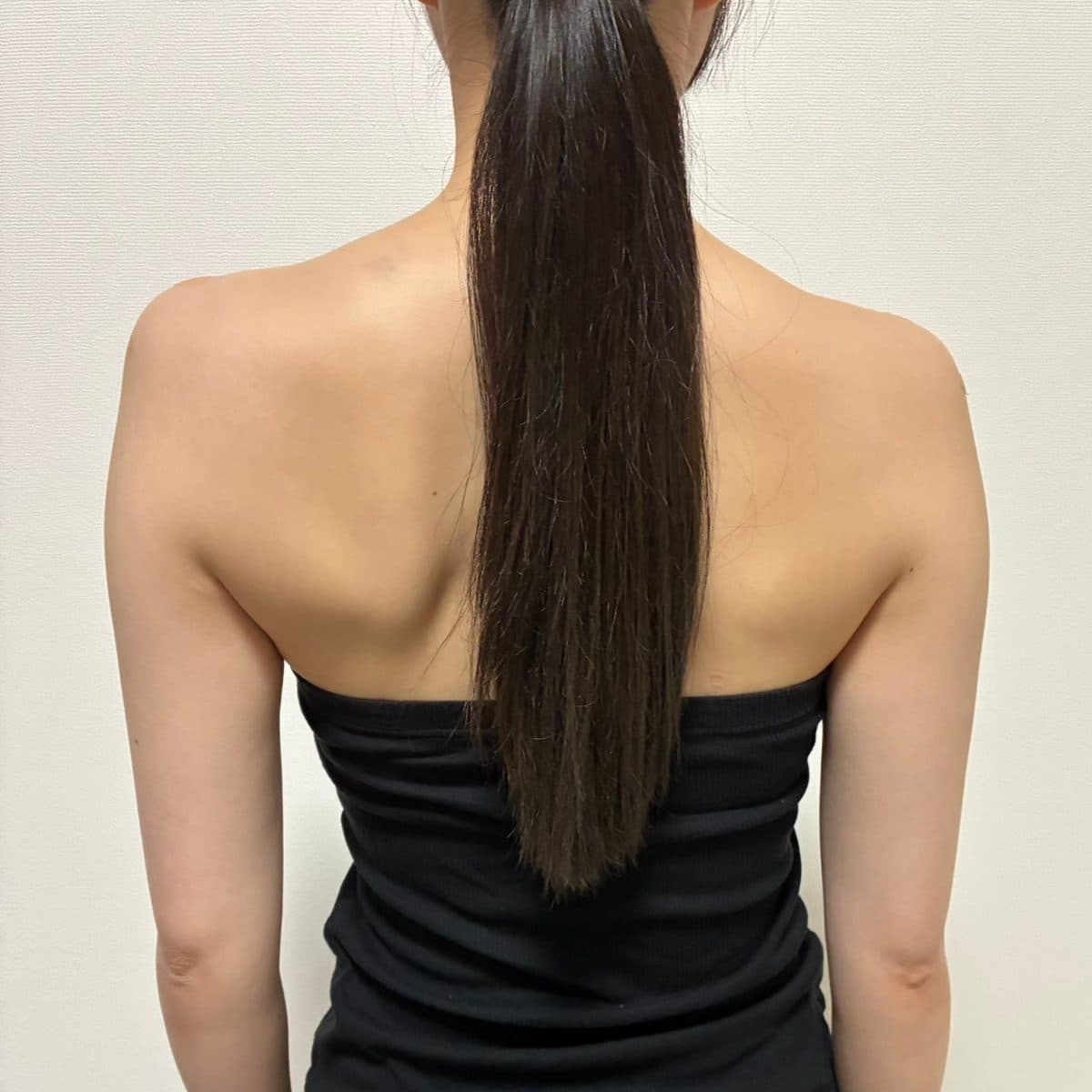 Shoulder & Collarbone Filler — after