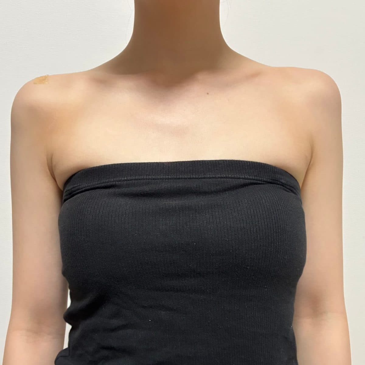 Shoulder & Collarbone Filler — after