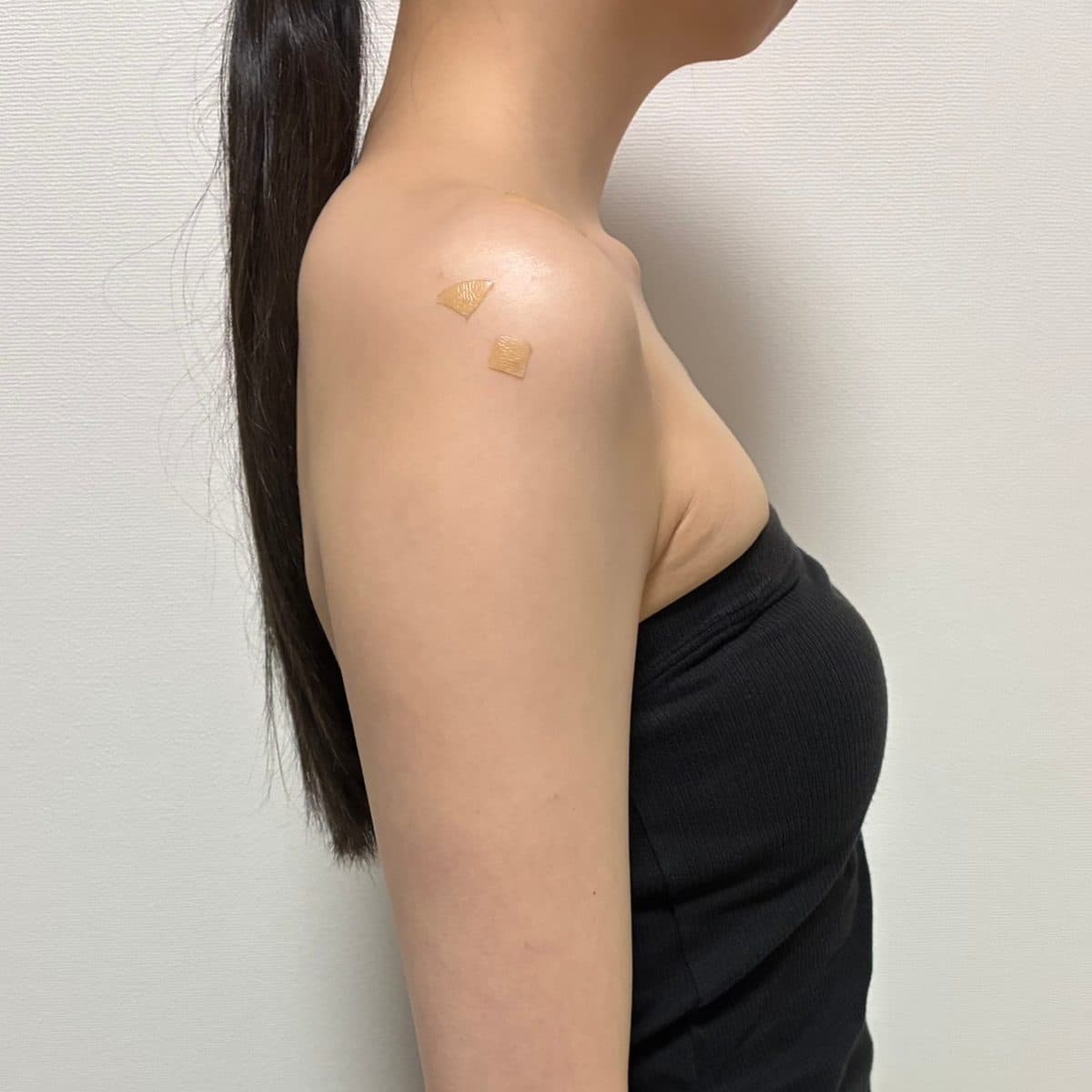 Shoulder & Collarbone Filler — after