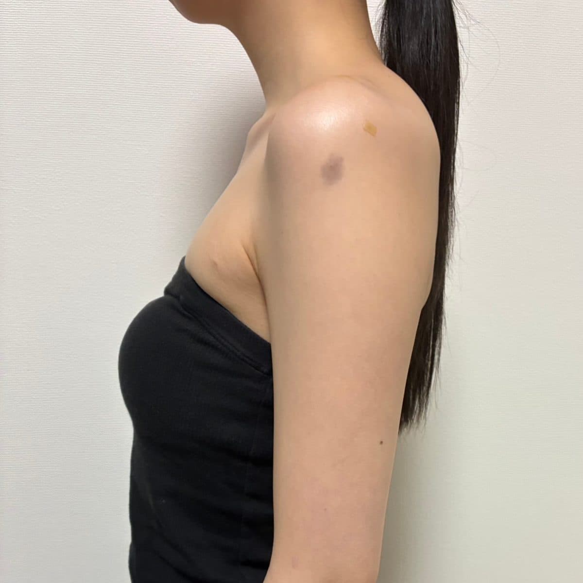 Shoulder & Collarbone Filler — after