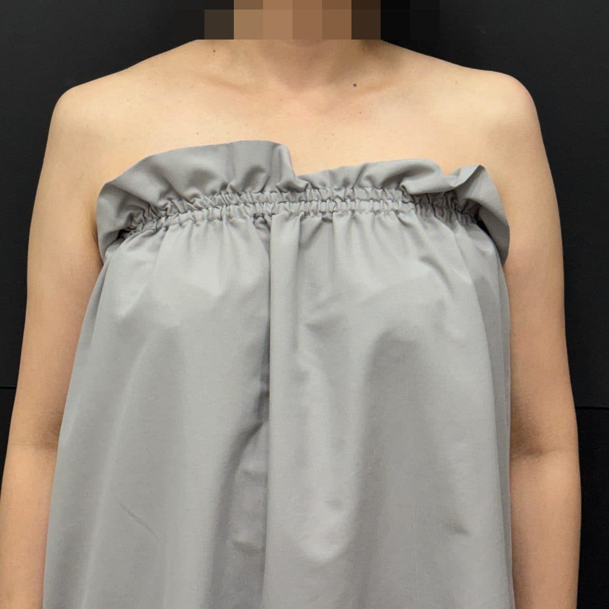 Shoulder & Collarbone Filler — after