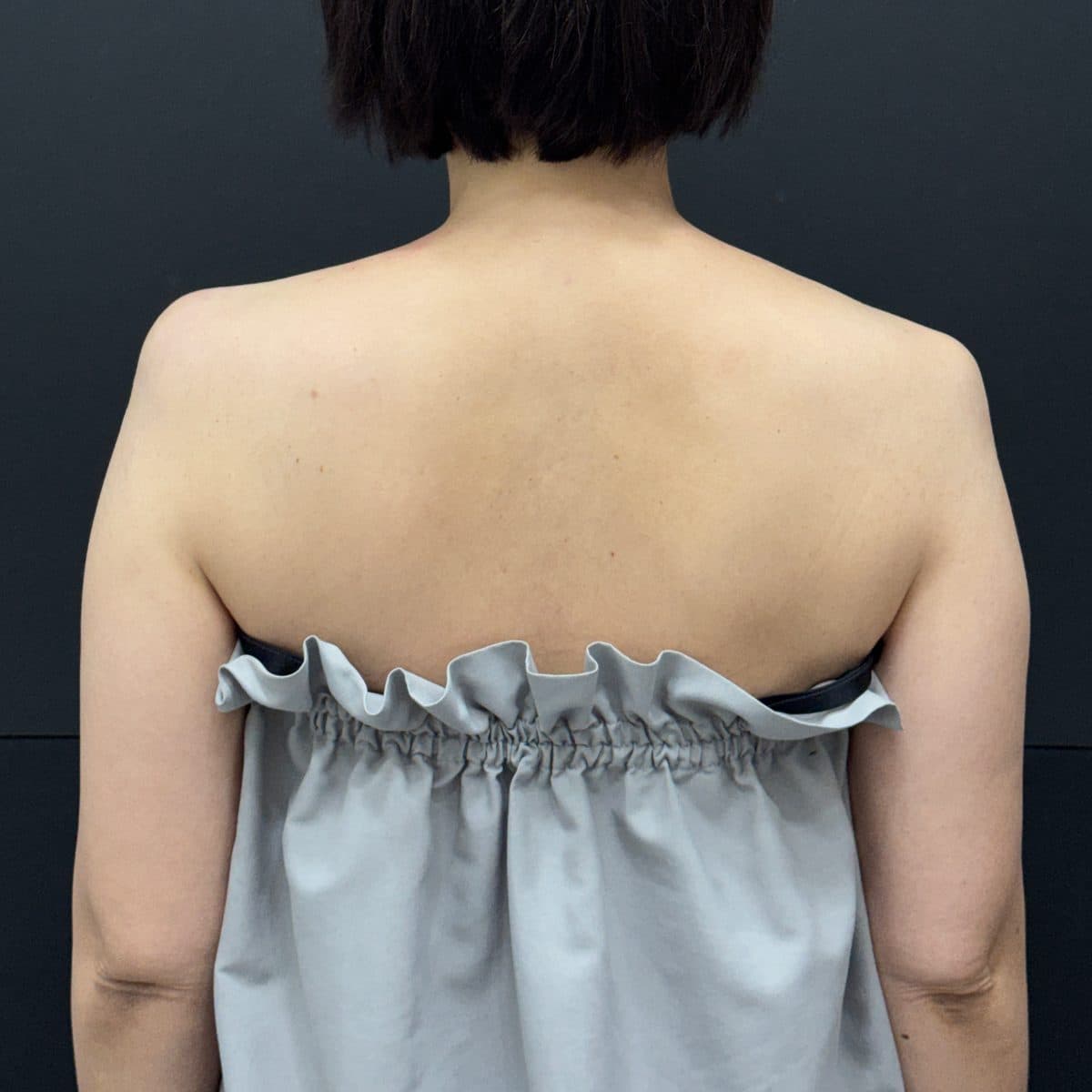 Shoulder & Collarbone Filler — after