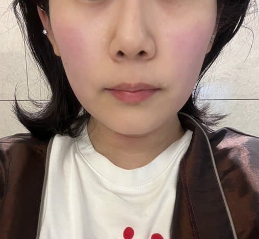 Dual-Line Tenti — after