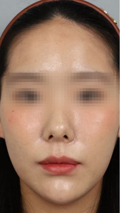 Custom Thread Lifting — After