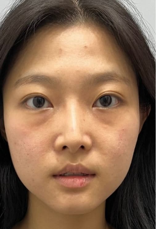 Custom Thread Lifting — Before